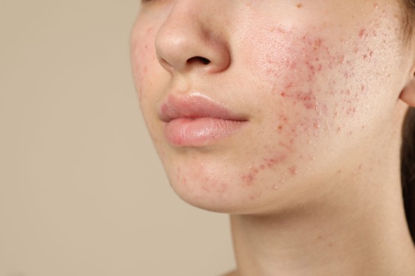 Single-Locus, Interaction, and Functional Pathway Analyses of Acne Severity in a 60-SNP Panel